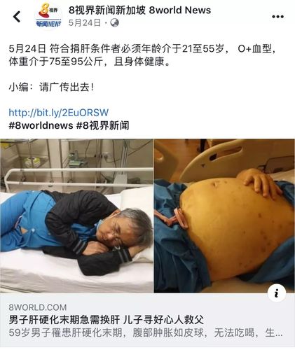 新加坡36岁男子无偿活体捐肝.