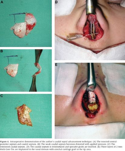 改进鼻中隔尾端矫正亚洲人短鼻缺陷