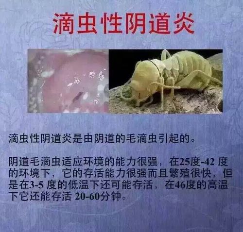 阴道滴虫真的是"虫"吗?比你想象的还要可怕!
