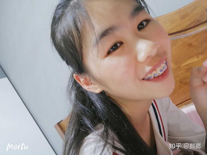 戴牙套(正畸)是什么体验?