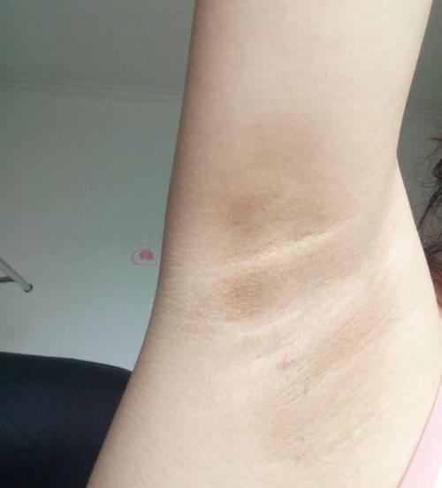 女性腋下黑是什么原因造成