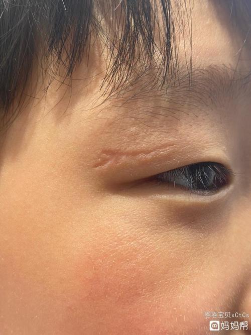 6岁女儿眼睛去年缝针疤痕,一年了,现在能