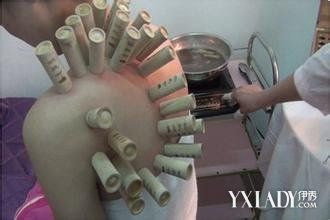 【图】中医拔罐减肥的位置图解 健康减肥