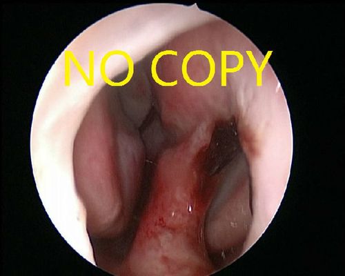 鼻中隔穿孔的预防与治疗