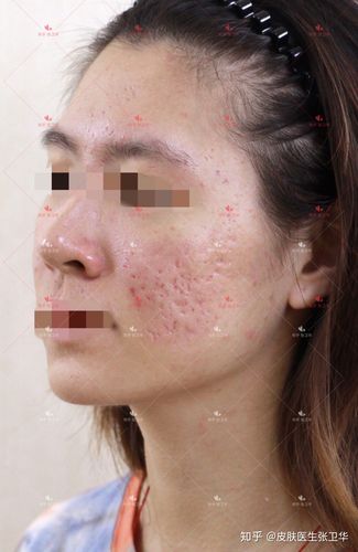 男生真的会不会介意女生的皮肤有痘坑?