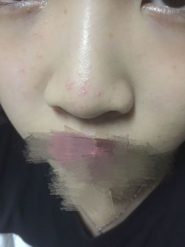 万能的网友,鼻头上还有旁边长了很多这种白头的小痘痘