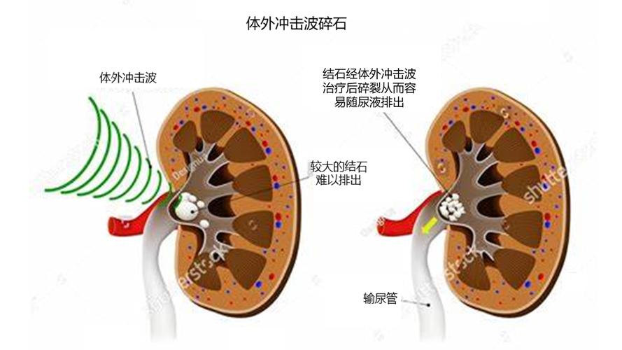 体外冲击波碎石