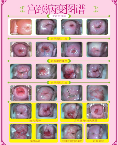 宫颈糜烂就是宫颈癌吗,出现那几个症状提示你宫颈癌,宫颈用什么保养最
