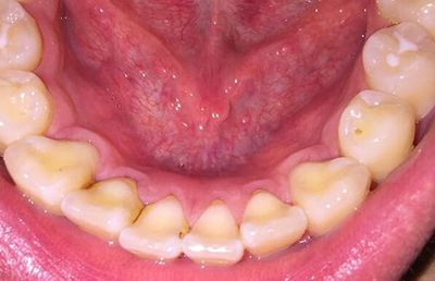 牙齿背面黑黑的东西到底是什么?