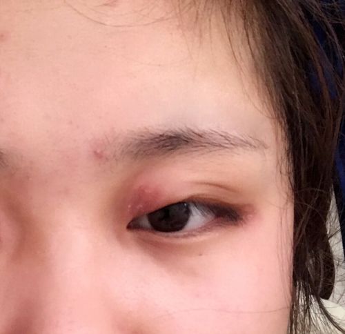 我年前得了神经性皮炎,好死不死的长在眼皮的位置,最近消得差不多了