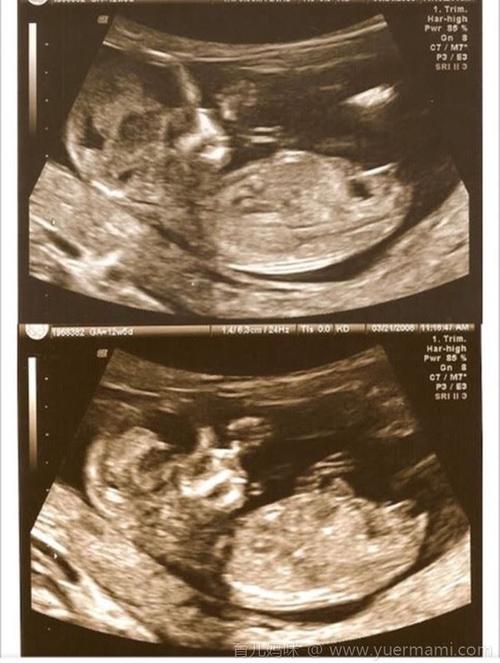 怀男孩的nt 已生男宝nt值参考