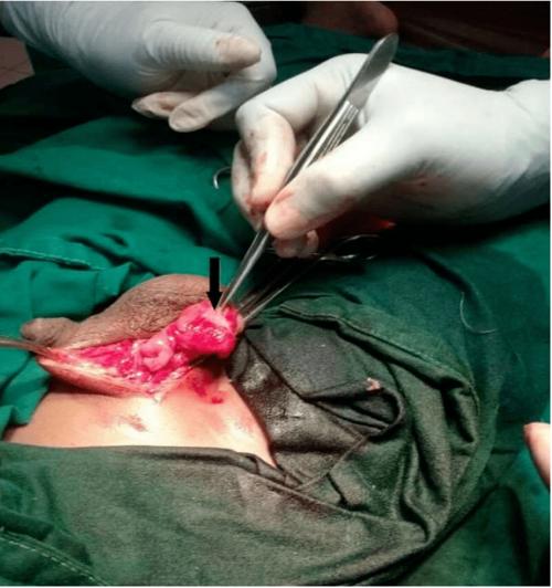 9 岁男孩在河里游泳后,睾丸长满了密密麻麻的虫卵