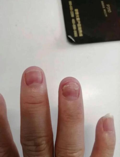 新的指甲终于快全部长出来了98_灰指甲_九福堂新亮甲_美妆_美甲