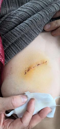 然后由我院外科团队完成手术切除活检.