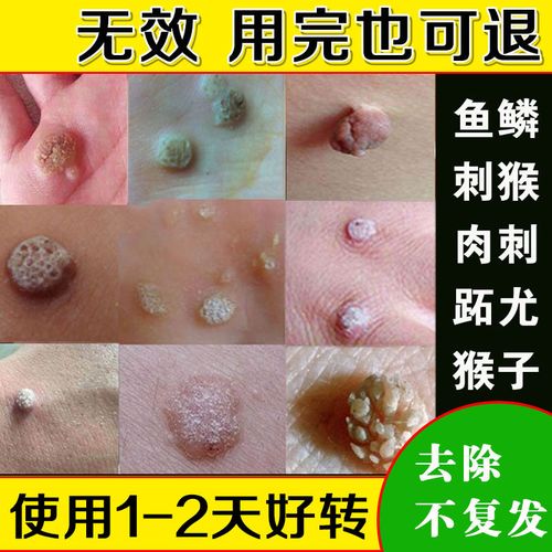 去鱼鳞痣贴刺猴去除正品修子药脚肉刺去除膏点祛猴子的鸡眼膏去根