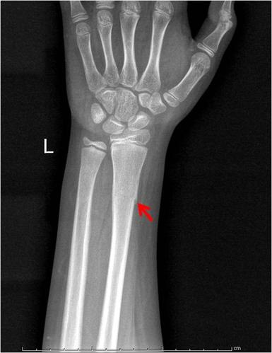 我让技术员给拍了片子,桡骨骨折!而且是典型的青枝骨折.