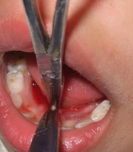 2021年了,还有人认为给孩子"剪舌根"就能口齿伶俐吗?