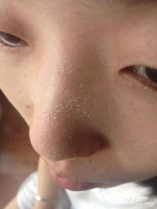 怀孕后脸部起皮