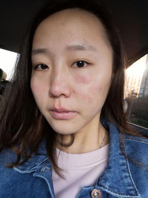 面部过敏性皮炎怎么办