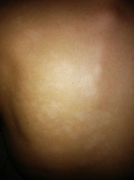 各位高手,我背上的白斑是花斑癣?