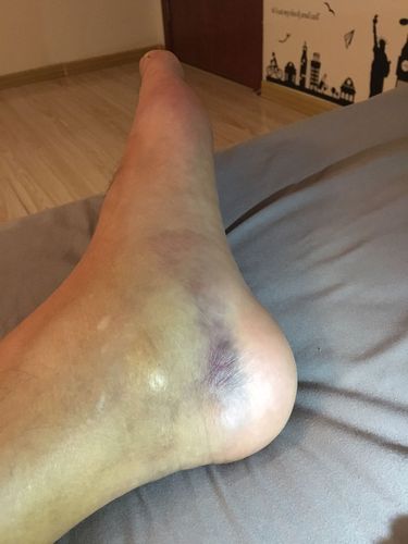 小腿肌肉被车撞挫伤,拍片骨头没问题,5天后消肿不明显