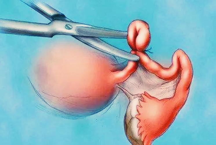 女人结扎是什么意思啊男性结扎是什么