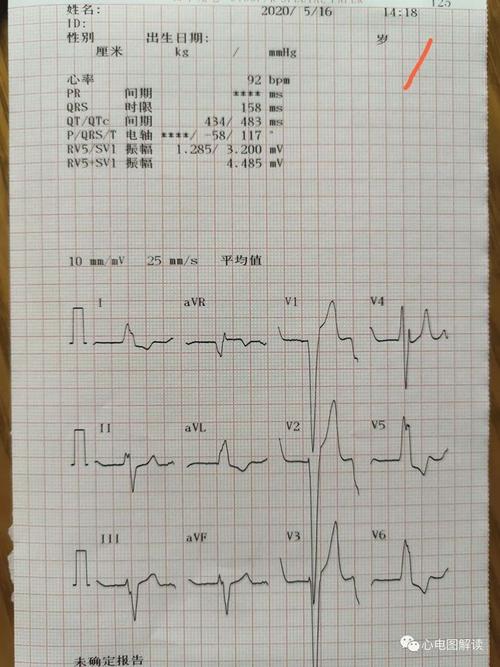 心电图解读完全性左束支传导阻滞合并缺血及鉴别