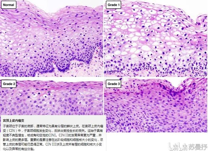 教材,见谅~ 病理切片 香烟烟雾引起的刺激已显示会导致鳞状上皮化生