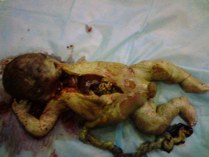 图解人流堕胎----"杀人工具"