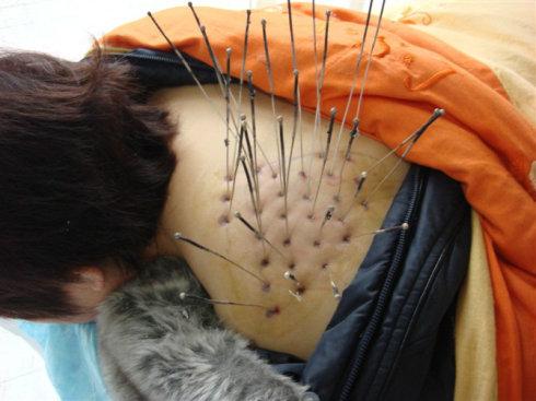 你见过这样布阵似的扎针灸吗?