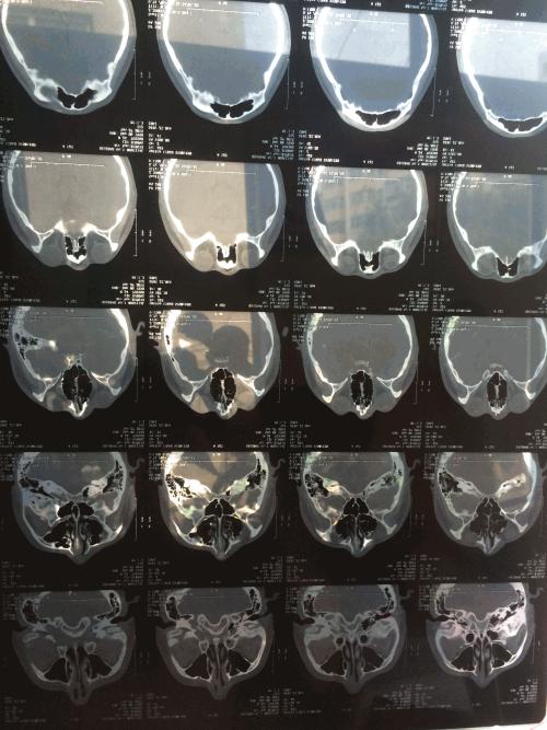 帮忙看下这个ct片子诊断是鼻骨骨折请问是什么性质的骨折