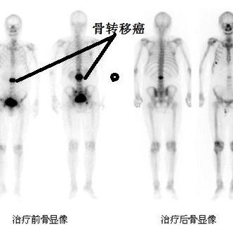 癌症发生骨转移应该怎么治疗