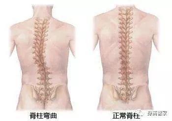 如果骨骼的生长发育出了问题比如太早学坐和错误坐姿导致的脊柱过度