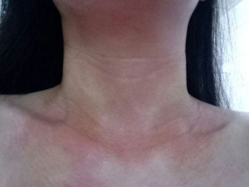 对一些有过敏体质的人,在吃中药时,一定要注意忌口问题