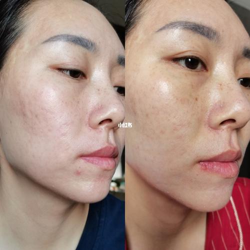 第一次光子嫩肤对比图_嫩肤_美妆_医美整形
