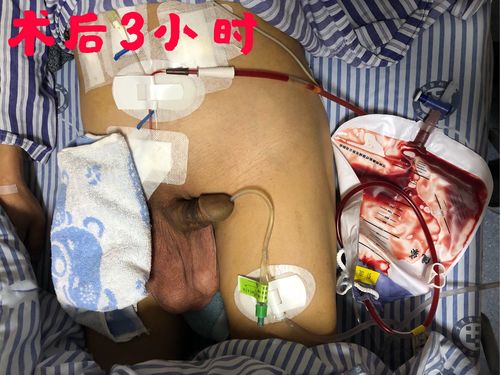 一例巨大阴囊疝tapp