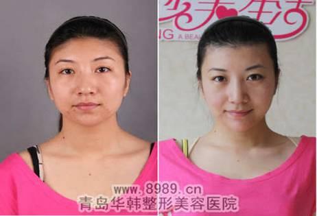 青岛华韩专家解析女生脱唇毛什么方法好