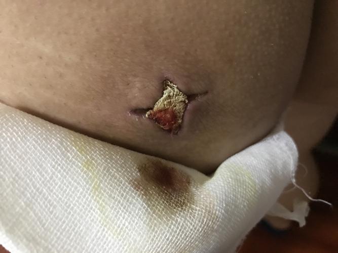 6月10日屁股上做了疖肿切开引流手术,到今天都快半个月咯!伤