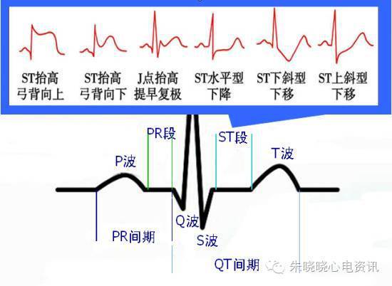 心肌梗死心电图诊断难点和要点,你掌握了吗?|心肌缺血