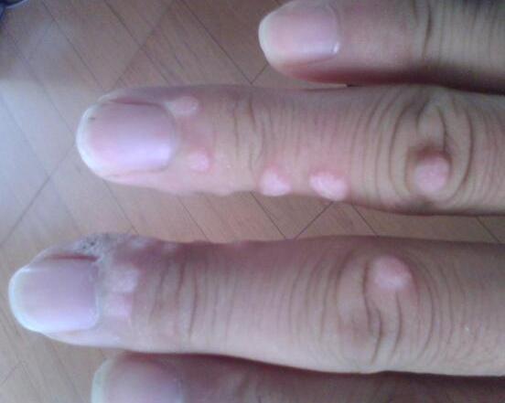 谁知道小孩手指上长的这个是什么,严重吗?不疼不痒,五岁了