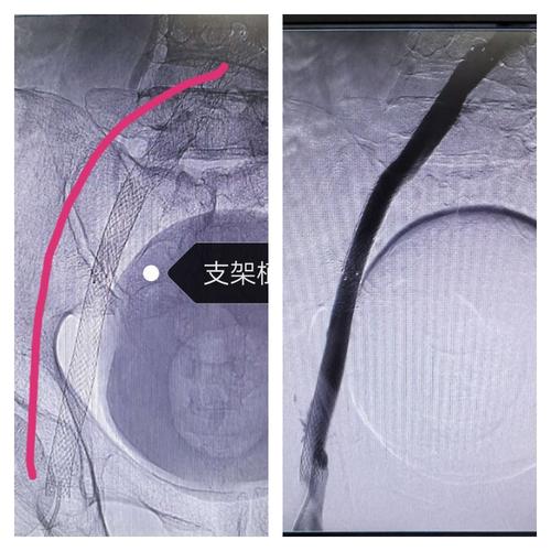【髂静脉狭窄科普】髂静脉狭窄(髂静脉压迫综合征),支架开通流出道,莫
