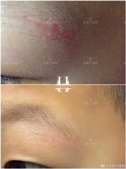 山东青岛,4岁多小宝宝意外磕伤,缝合愈合后,留下了明显的外伤疤痕.