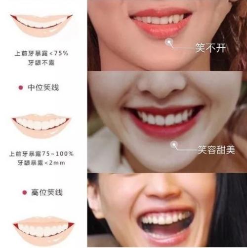 dsd数字美齿设计get"女团微笑",让你的牙齿c位出道