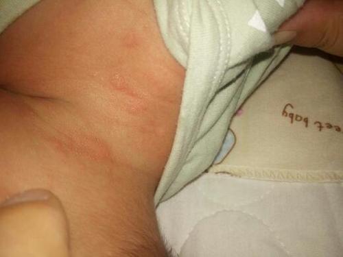 婴儿脖子长了好多红疙瘩,一块一块的!不知道是什么,怎么治疗呀!