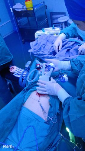 我院妇科成功开展单孔腹腔镜下宫外孕手术治疗