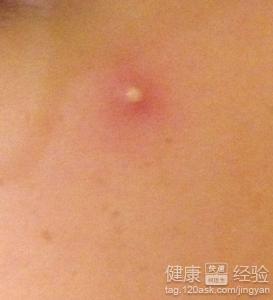 脓包的原因,脓包怎么引起的