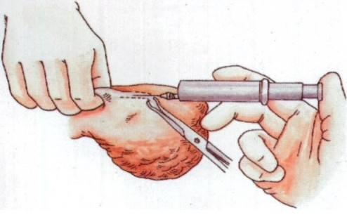 女人"上环"和男人"结扎",哪种该首选,看到结局扎心了