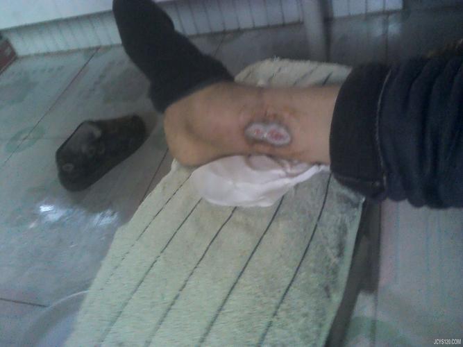 治疗一例糖尿病并发症——右小腿内侧肌肉坏死