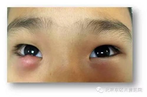 宝宝长了"麦粒肿"该怎么办?注意!严重了可得做手术!
