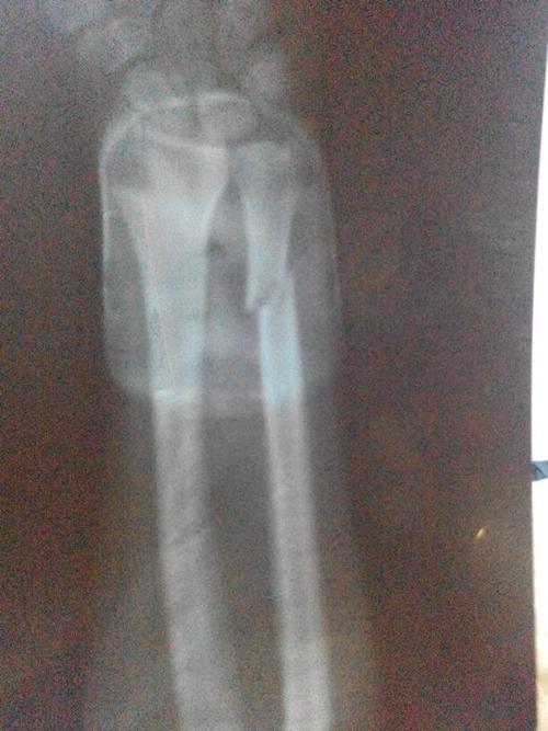 胳膊骨折捏后15成这个样子请问有什么办法可以再矫正吗?除了做手术